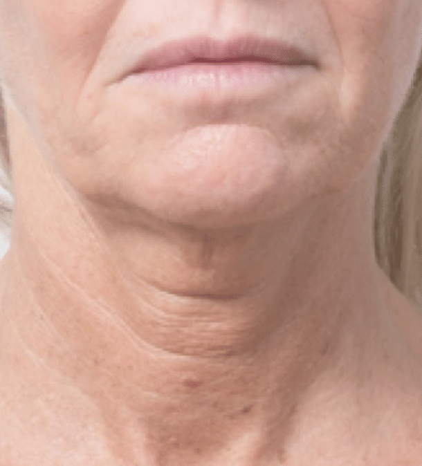 profhilo-肌底細胞活化-before2